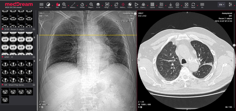 HubBucket's tweet photo. #COVIDNet-#CT | A Tailored Convolutional #NeuralNetwork Design for Detection of #COVID19 Cases from Chest #CT #MedicalImaging
#MedTech
#Radiology
#DataScience
#MachineLearning
#DeepLearning
🖥️https://t.co/JgNlTi3MOX
@HubBucket @ProsumerSoft @HubMedX https://t.co/MbT7tHakqZ