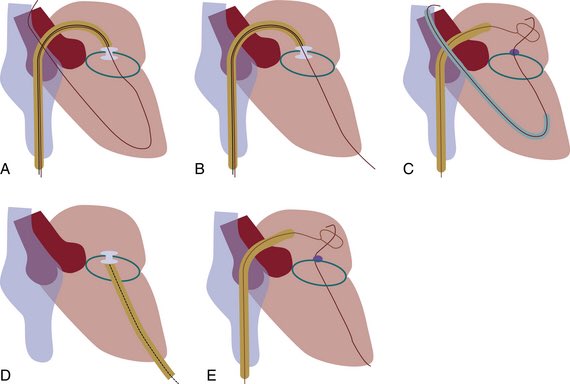 Generally, close if symptomatic PVL (HF or hemolysis) or chamber enlargement. Trans-septal for MV and retrograde aortic for AV. Thorough overview article by  @EleidMack on the topic.  https://www.ahajournals.org/doi/full/...