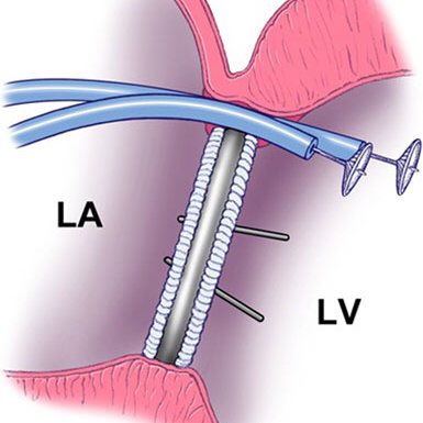 AVP II usually selected as it has 3 sections, and the middle lobe sits in the leak.