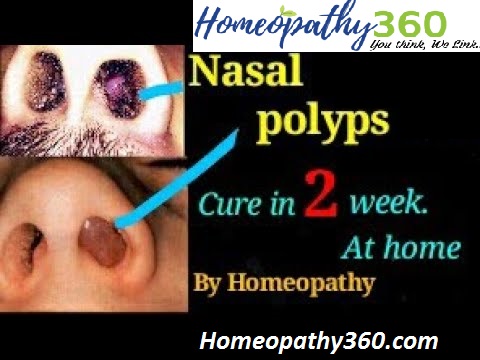 Nose polyps home remedy
