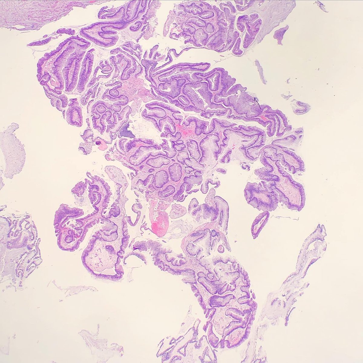 SueEPig's tweet photo. #pathconsult 80M follow up for urinary retention and BPH with outflow obstruction. Biopsies are from prostatic urethra. (1/2)
How would you approach? 🔬🤨 #gupath @DrGeeONE https://t.co/LnamkpG996