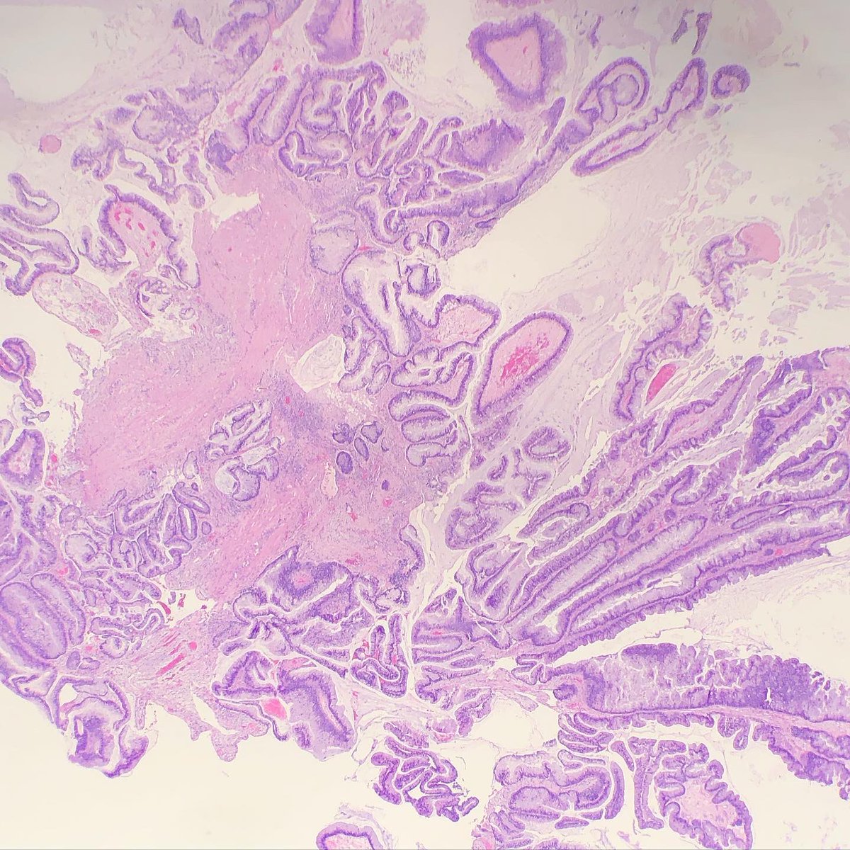 SueEPig's tweet photo. #pathconsult 80M follow up for urinary retention and BPH with outflow obstruction. Biopsies are from prostatic urethra. (1/2)
How would you approach? 🔬🤨 #gupath @DrGeeONE https://t.co/LnamkpG996