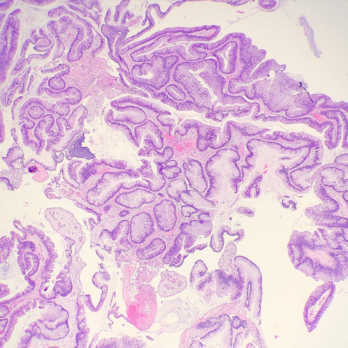 SueEPig's tweet photo. #pathconsult 80M follow up for urinary retention and BPH with outflow obstruction. Biopsies are from prostatic urethra. (1/2)
How would you approach? 🔬🤨 #gupath @DrGeeONE https://t.co/LnamkpG996