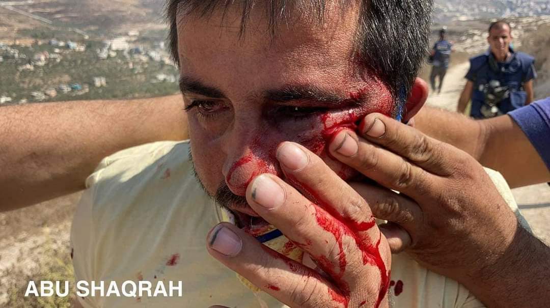 AyaIsleemEn's tweet photo. 🇵🇸#Palestine || Palestinians carry a young man who was injured after being hit by by tear gas canister in the face during the clashes with Israeli occupation and settlers in Asira village near Nablus. https://t.co/9aSCeNngDd