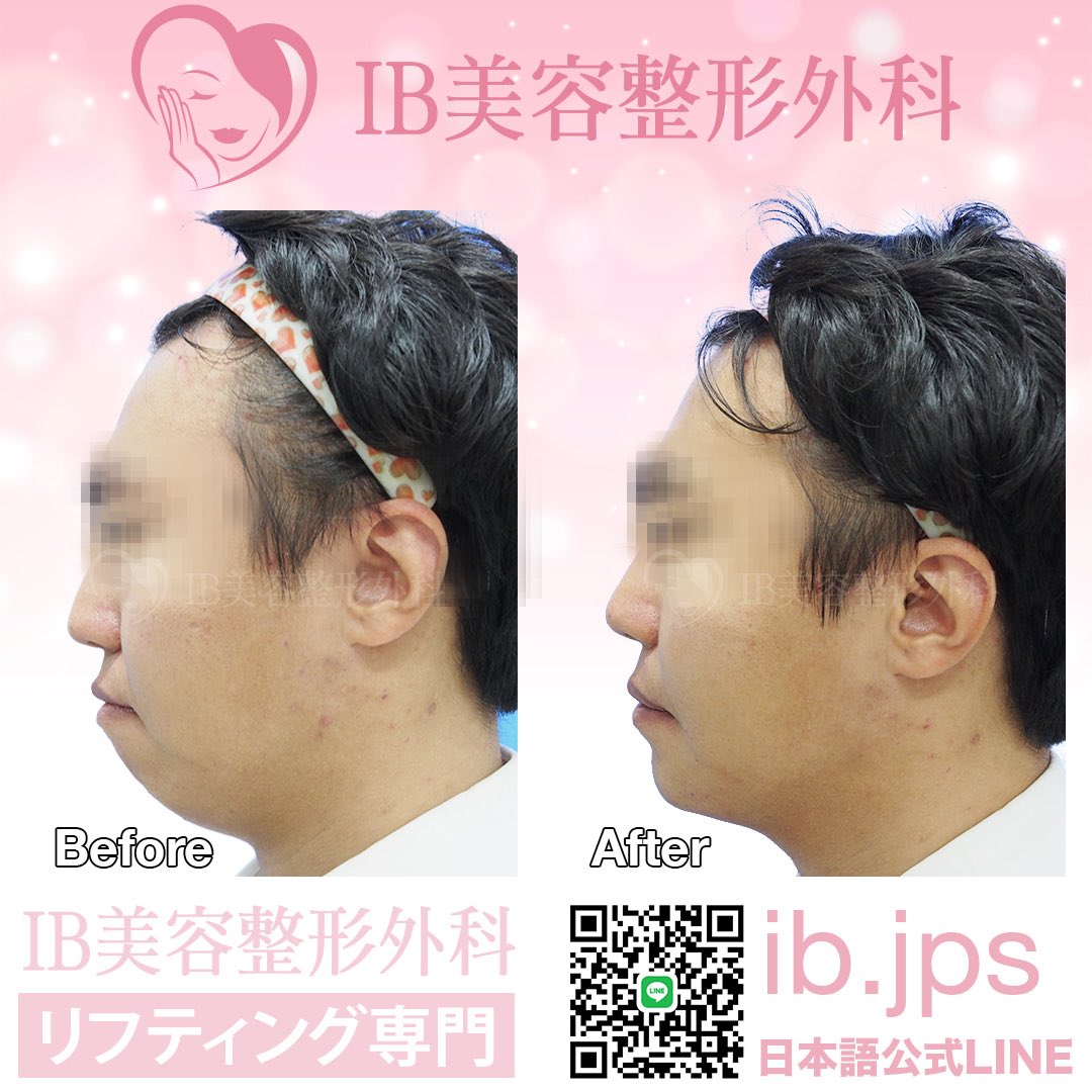 アイビー美容整形外科 韓国ソウル 顎フィラーはたった数分で痛みも少なく形もバランスも整った綺麗でシャープな顔立ちに形成します 小顔の印象にしたい方 顎をシャープにしたい方 顎先が割れている方 二重顎でお悩みの方 顎フィラー 小顔 アイビー美容整形外科 韓国ソウル 顎フィラーはたった数分で痛みも少なく形もバランスも整った綺麗でシャープな顔立ちに形成します 小顔の印象にしたい方 顎をシャープにしたい方 顎先が割れている方 二重顎でお悩みの方 顎フィラー 小顔