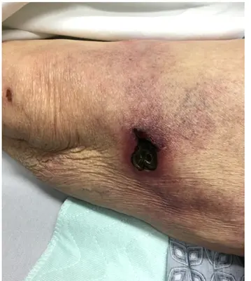 BID_CMRs's tweet photo. Calling all med students and residents! Time for #Mediaoftheweek
80F PMH AF on anticoagulation, HFpEF, CAD p/w exquisitely tender #rash and ulcers of her thighs
#Questions below re: risk factors and tx
Answers up this PM
Thanks twitterless Nick Spetko for the case! 1/ https://t.co/L7LTZLfitJ