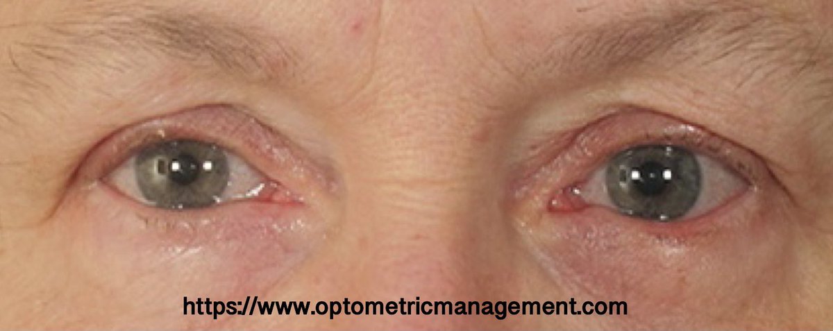 🔰 تدميع العين لدى كبار السن 👁🔰

مشكلة شائعة

قد يكون من أسبابها ⤵️

- جفاف العين 
- حساسية بالعين 
- ارتخاء الجفن السفلي 

ينصح بزيارة دكتور البصريات أو طبيب العيون لتشخيص السبب وصرف العلاج المناسب ✅