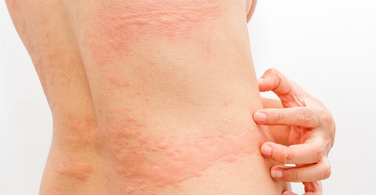 BongeLaAfya's tweet photo. UZI: Mkanda wa Jeshi: Ugonjwa huu kitaalamu unajulikana kama shingles au herpes zoster. Ni ugonjwa wa ngozi unaosababishwa na virusi aina ya Varicella-zoster. Ambacho ulikua hujui ni kuwa virusi hivi hivi pia ndio husababisha tetekuwanga "Chicken pox". #BongeLaAfya https://t.co/CVkuMndECM