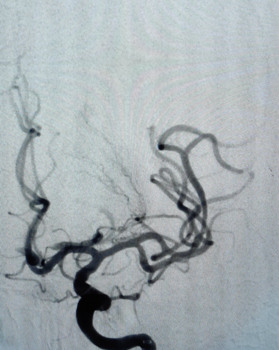 Federico Zarco (@federicozarco) on Twitter photo Trombectomía arteria cerebral media izq.
Técnica: ARTS (Aspiration-Retriever Technique for Stroke).
Tiempo de procedimiento: ⌛10 min
Stent : <a href="/Stryker_NV/">StrykerNeurovascular</a> Trevo 6x25mm
Catéter de aspiración distal: AXS Catalyst™ 6 Trombectomía arteria cerebral media izq.
Técnica: ARTS (Aspiration-Retriever Technique for Stroke).
Tiempo de procedimiento: ⌛10 min
Stent : <a href="/Stryker_NV/">StrykerNeurovascular</a> Trevo 6x25mm
Catéter de aspiración distal: AXS Catalyst™ 6