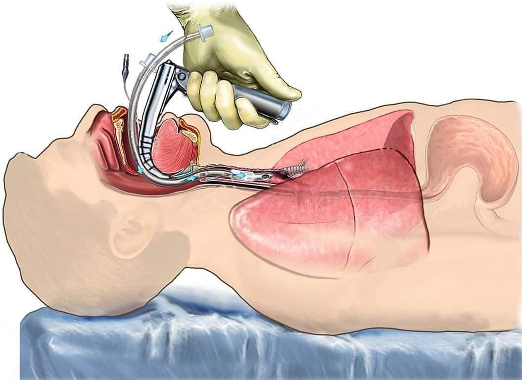 I wanted to share this picture of intubation, which is done in order to hook a patient up to a ventilator. Just in case you are complaining that you don’t want to wear a mask today because it’s ‘uncomfortable.’