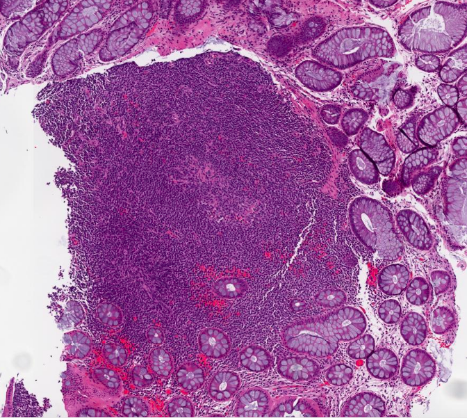 SibaElHussein's tweet photo. (1/5) Answers of yesterday's session with @ljmedeirosMD :
@KirillLyapichev #hemepath #hemepathMDA #virtualhemepathMDA
🚩Case 1 : CLL/SLL involving GI tract
Notice the 2-toned CD5 positive staining (bright in background T-cells, dim in neoplastic B-cells) https://t.co/MY2UGtg5u0