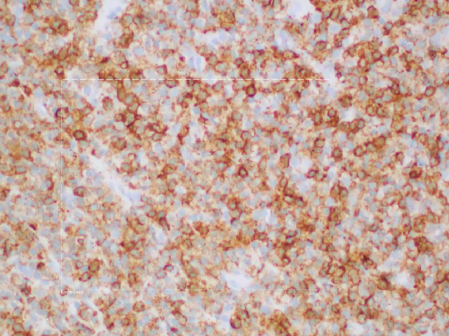 SibaElHussein's tweet photo. (1/5) Answers of yesterday's session with @ljmedeirosMD :
@KirillLyapichev #hemepath #hemepathMDA #virtualhemepathMDA
🚩Case 1 : CLL/SLL involving GI tract
Notice the 2-toned CD5 positive staining (bright in background T-cells, dim in neoplastic B-cells) https://t.co/MY2UGtg5u0