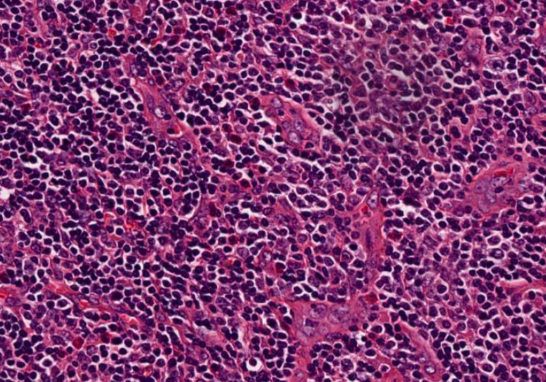 SibaElHussein's tweet photo. (2/5) 🚩Case 2 : AITL
A challenging mimicker is MZL (both AITL and MZL have a perifollicular pattern of growth and cytoplasmic clearing)
#hemepath #hemepathMDA #virtualhemepathMDA https://t.co/QOGYtmNIAY