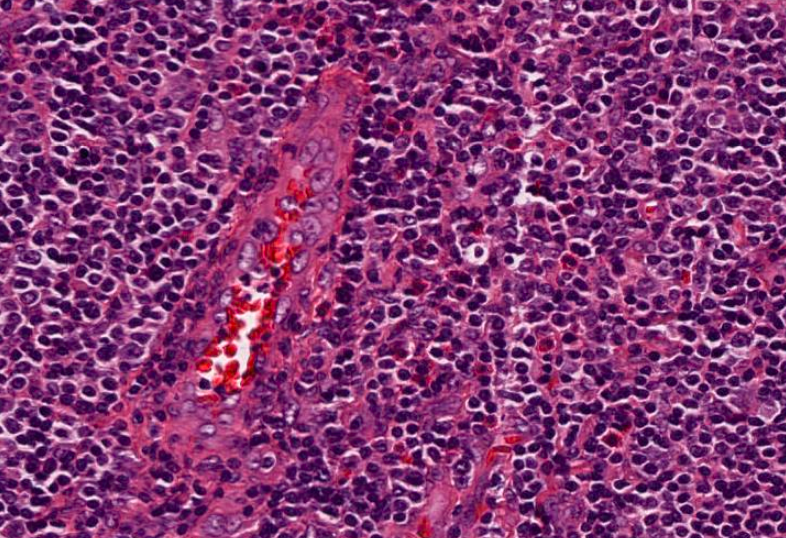 SibaElHussein's tweet photo. (2/5) 🚩Case 2 : AITL
A challenging mimicker is MZL (both AITL and MZL have a perifollicular pattern of growth and cytoplasmic clearing)
#hemepath #hemepathMDA #virtualhemepathMDA https://t.co/QOGYtmNIAY