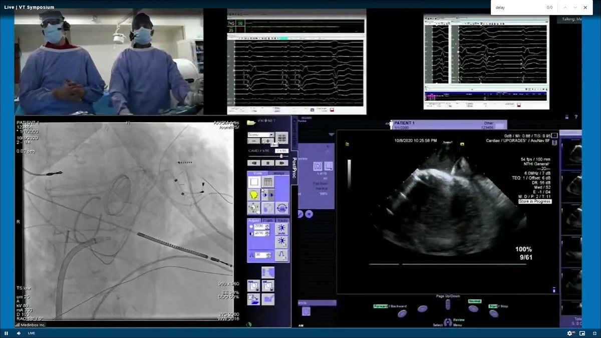 Live cases from @VTSymposium with #PennEP (@krishpothineni, @rdschaller, @Dr_Santangeli) demonstrating a novel approach for LV access (iatrogenic Gerbode defect) with dual mechanical valves. jamanetwork.com/journals/jamac… #EPeeps #Cardiotwitter #AblateVT