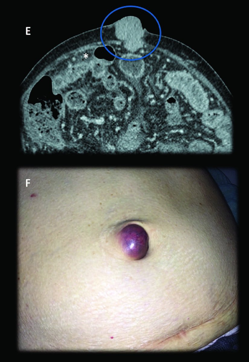 When she scrubbed abdomens before laparotomies, Sister Mary Joseph noticed that whenever there was a firm mass near the umbilicus, the patient turned out to have cancer. Will Mayo published an article in 1928  @MayoProceedings about this – he called it “pants button umbilicus.” /3