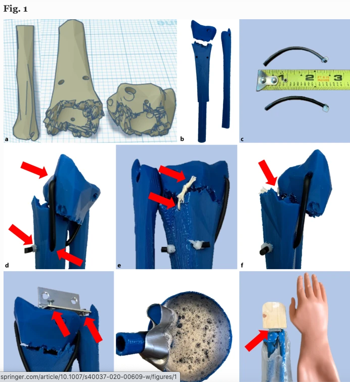 Looking to improve your distal radius fracture reduction education? Check out this easy-to-make 3D printed simulator that facilitates procedural training by @wdixon1487 link.springer.com/article/10.100… #SBML #meded #3DPrinting @StanfordEMED #Simulation