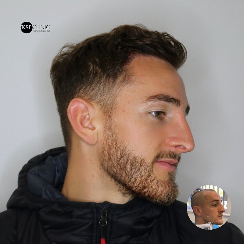 KSL_Clinics's tweet photo. ⚽️ Footballer Tom Lockyer doubles up on 𝐅𝐔𝐄 𝐇𝐚𝐢𝐫 + 𝐁𝐞𝐚𝐫𝐝 𝐓𝐫𝐚𝐧𝐬𝐩𝐥𝐚𝐧𝐭 at KSL Clinic!
🏴 Luton Town and Wales National footballer visited us recently for a session of PRP Treatment.
#KSLClinic #DrMatee #FUE #HairTransplant #BeardTransplant #TomLockyer https://t.co/kMoPhfzYUh