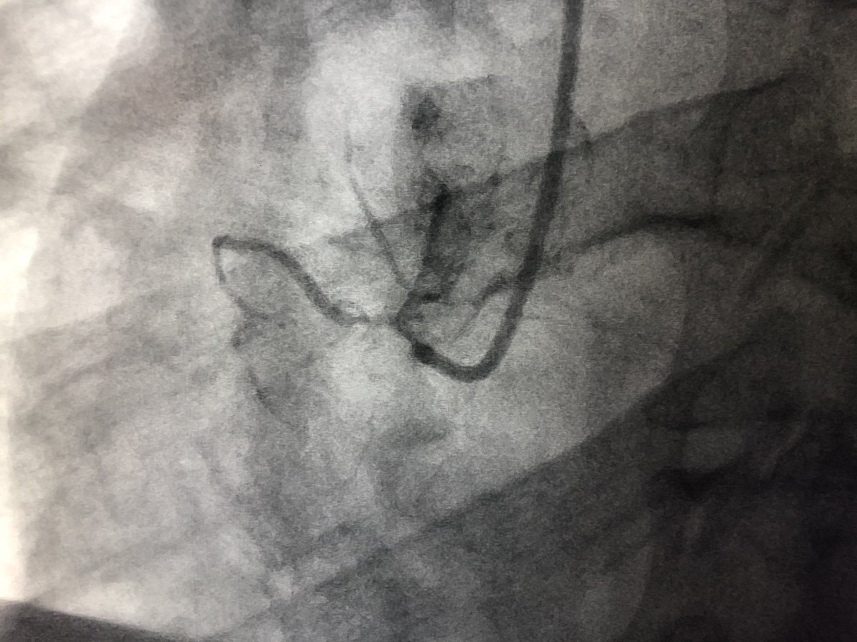 DrAmirKaki's tweet image. 62 y/o male presents with NSTEMI.  Boarded for cath in am.  Prior to cath VT arrest and on vasopressors Findings at cath, severe LAD, CTO LCx, CTO RCA.  LVEDP 34mmhg, EF 10%.  Severe PAD.  Rx with IC fellow sticks #PercAx Impella and IVUS guided revasc.  Now off vasopressors.