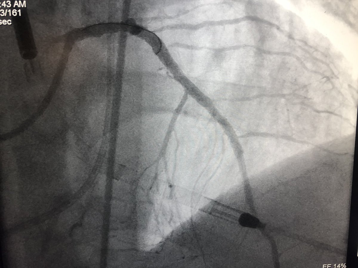 DrAmirKaki's tweet image. 62 y/o male presents with NSTEMI.  Boarded for cath in am.  Prior to cath VT arrest and on vasopressors Findings at cath, severe LAD, CTO LCx, CTO RCA.  LVEDP 34mmhg, EF 10%.  Severe PAD.  Rx with IC fellow sticks #PercAx Impella and IVUS guided revasc.  Now off vasopressors.