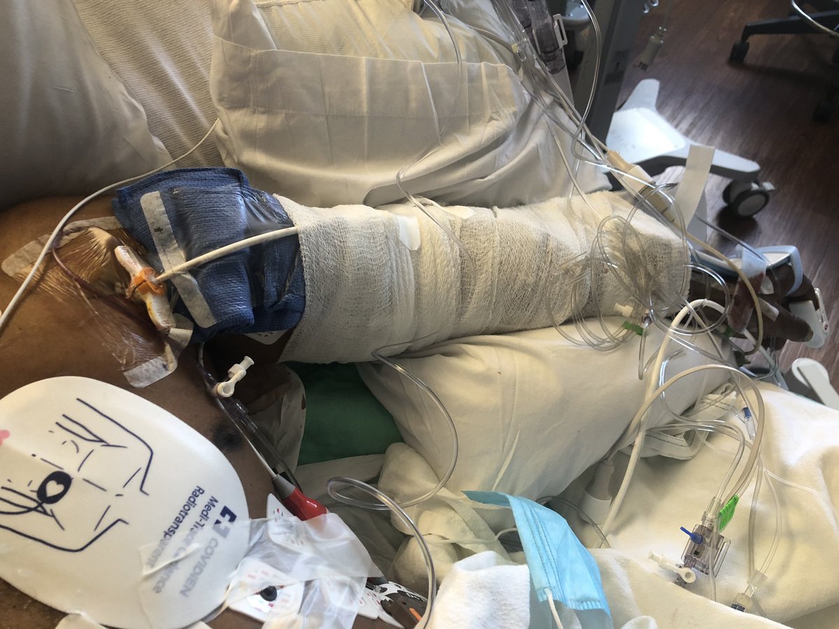 DrAmirKaki's tweet image. 62 y/o male presents with NSTEMI.  Boarded for cath in am.  Prior to cath VT arrest and on vasopressors Findings at cath, severe LAD, CTO LCx, CTO RCA.  LVEDP 34mmhg, EF 10%.  Severe PAD.  Rx with IC fellow sticks #PercAx Impella and IVUS guided revasc.  Now off vasopressors.