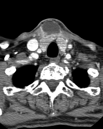 The famed "Delphian node" is an enlarged midline pretracheal lymph node. It is named after the famous prophetic Oracle of Delphi in Pythia, Greece, since it augurs either thyroid or laryngeal disease. (CT image: Radiopedia) /10