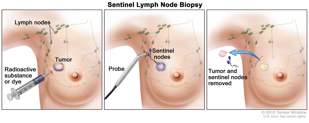 Sentinel nodes are not specific lymph nodes - and aren’t named after a Dr. Sentinel! The term ultimately derives from the Latin ‘sentire’ = to feel/sense, and reflects the sentinel as a person who watches & sounds a warning at the sign of trouble. Also called “signal nodes.”/19