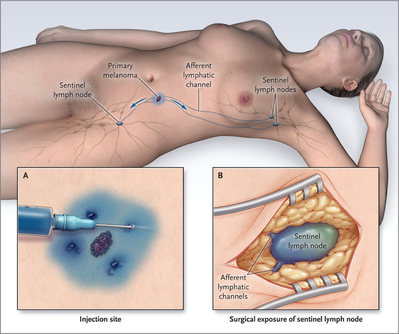 Sentinel nodes are not specific lymph nodes - and aren’t named after a Dr. Sentinel! The term ultimately derives from the Latin ‘sentire’ = to feel/sense, and reflects the sentinel as a person who watches & sounds a warning at the sign of trouble. Also called “signal nodes.”/19