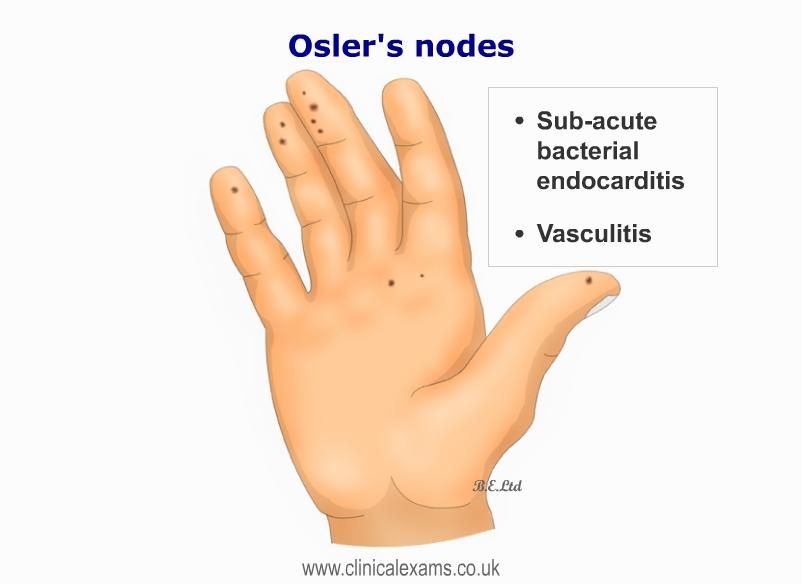 Many eponymous “nodes” aren't lymph nodes: Osler nodes (immune complexes in skin in endocarditis), Heberden & Bouchard nodes (finger DJD), node of Aschoff/Tawara (cardiac AV node), Flack/Keith node (sinoatrial), Schmorl node (vertebral defect), Parrot node (syphilis skull) etc/20