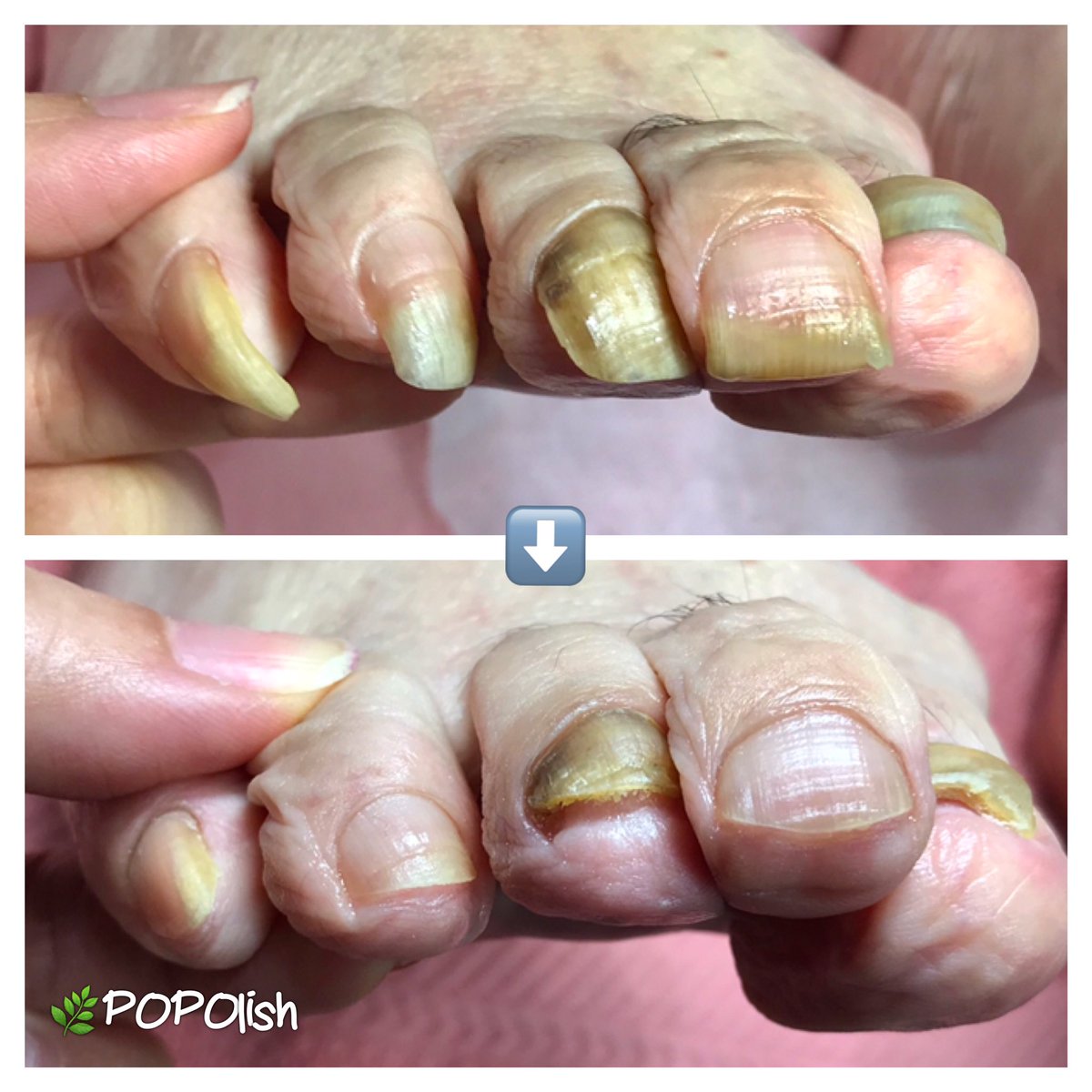ネイルサロンpopolish 身内の方の助けが必要です 歳をとると自分ではなかなか足の爪の管理が出来ません 歩けなくなる前に確認してあげてください 年配 視力の低下 足の爪 出血 車椅子 病院通い 中野 練馬 豊島区 都立家政 鷺宮 沼袋