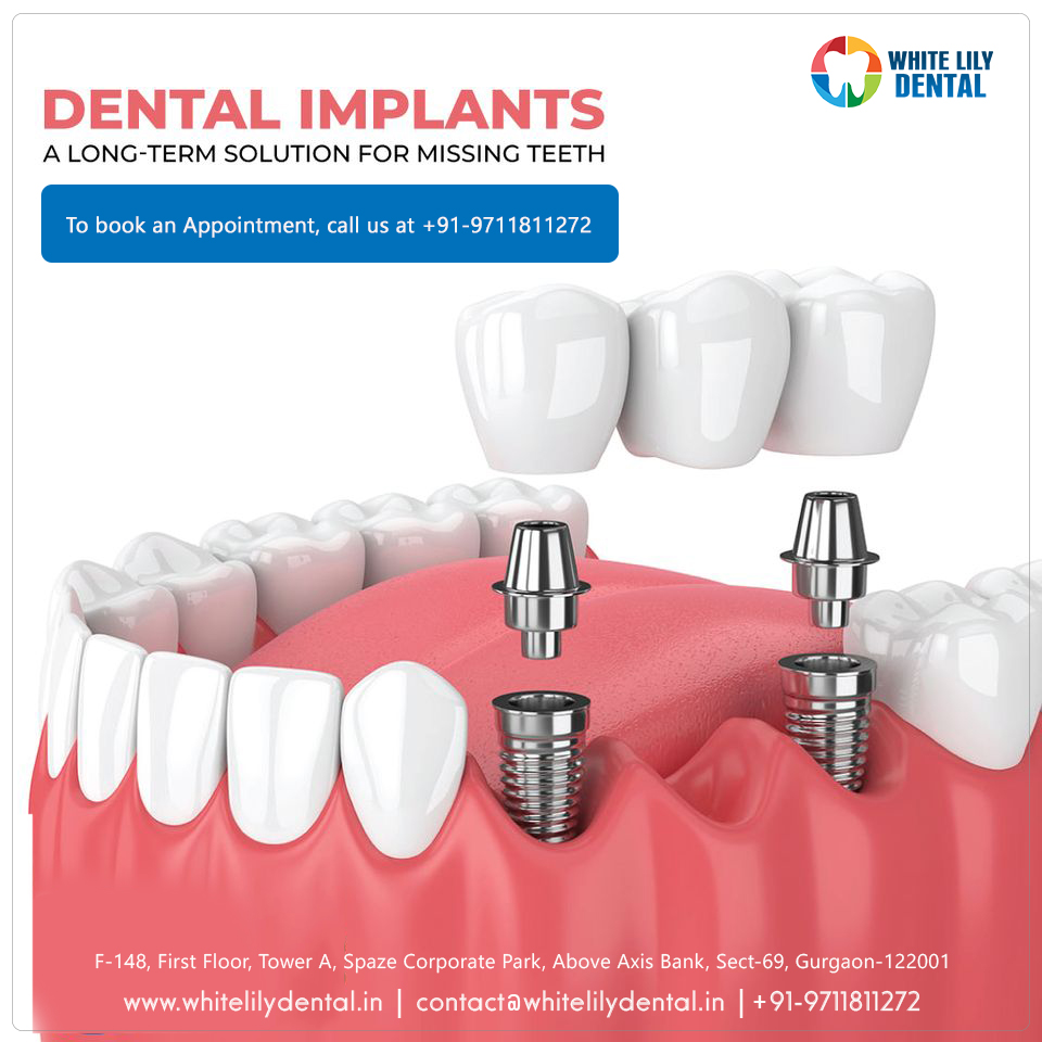 whitelilydental's tweet photo. Dental implants treatment services in Gurgaon.
Consult and book an appointment at +91-9711811272 with our expert dentist at white lily dental.
For more information visit https://t.co/tOfVC89Hv2.
.
.
.
#toothcare #tipsofday #perfectsmile #healthyteeth #happylife #whitesmile https://t.co/GYxEOX3qdT