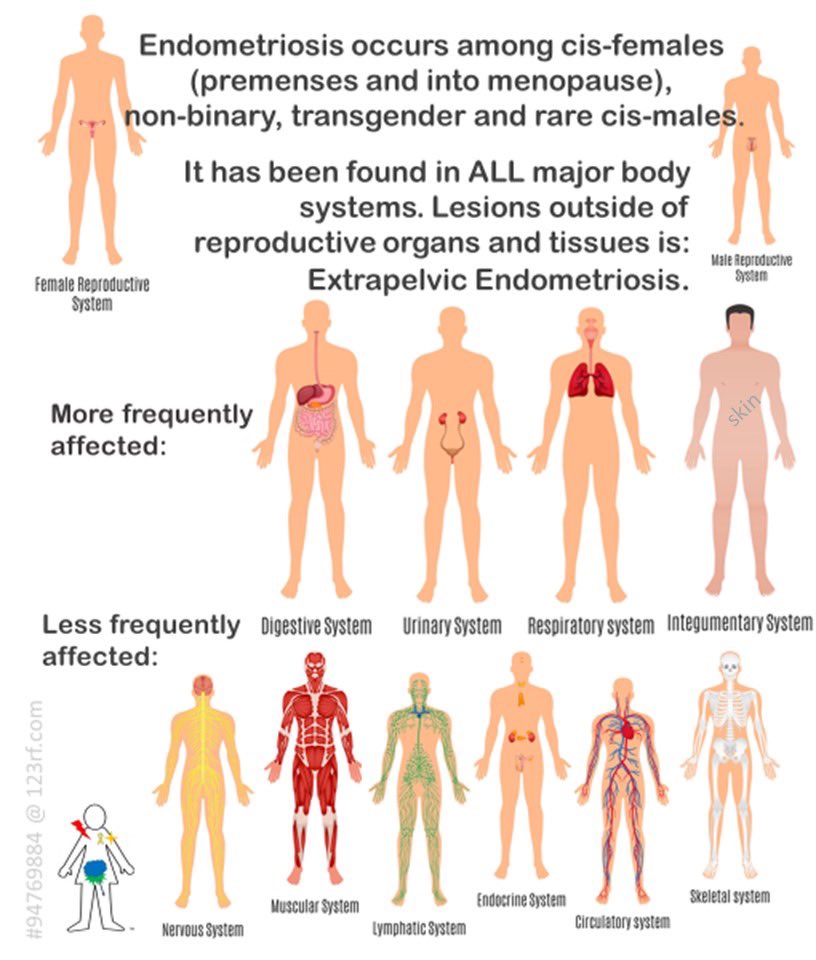 XtraNotRare's tweet image. Follow along the short new slide series to raise awareness about the #bodywide lesion potential of #endometriosis. #ExtrapelvicNotRare instagram instagram.com/p/CGHRGaAjYS-/…