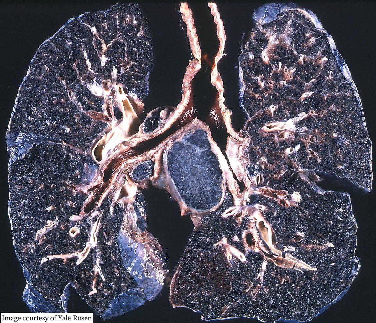 7/20 Through their work miners also risked a variety of pit-induced ailments, including lung diseases like miners’ pneumoconiosis or ‘black lung’, and silicosis. Image: coal workers’ pneumoconiosis - anthracosilicosis, black pigmentation and fibrosis of lungs   #HiddenLandscapes