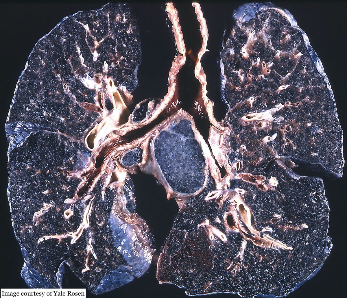 7/20 Through their work miners also risked a variety of pit-induced ailments, including lung diseases like miners’ pneumoconiosis or ‘black lung’, and silicosis. Image: coal workers’ pneumoconiosis - anthracosilicosis, black pigmentation and fibrosis of lungs  #HiddenLandscapes