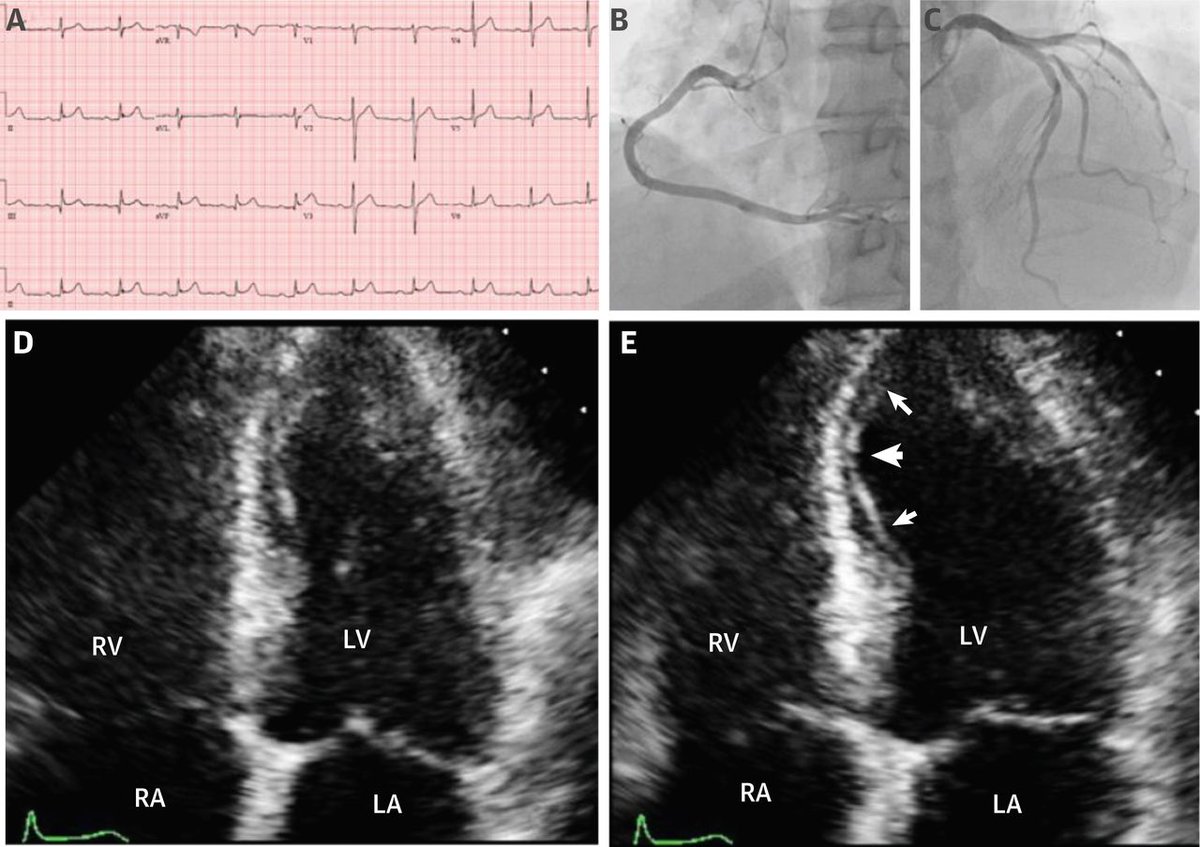 Can ergonovine #cvEcho replace invasive diagnosis of coronary vasospasm?  #JACCIMG presents the findings and prognosis of ergonovine #EchoFirst in this definitive experience of over 14,000 patients in South Korea. 🇰🇷 bit.ly/2GGIbFs