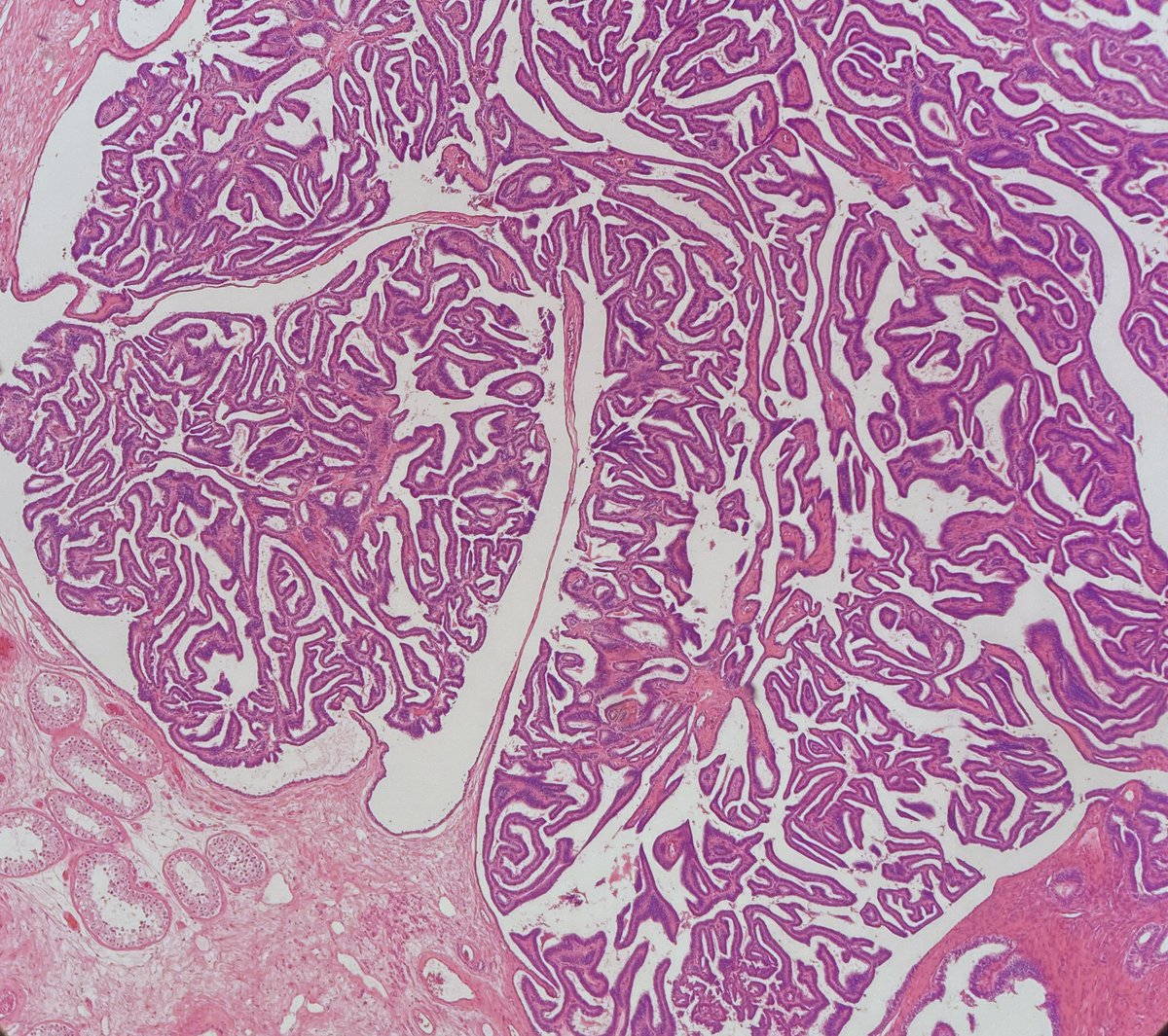 daniel_berney's tweet image. Let us finish the week with a beauty and a real rarity. A papillary cystadenoma of the rete testis. Somehow I feel I might persuade others, a WSI can make its way into the WHO 2021 testis blue book which I have the privilege of editing with @ro36693000 and Dr Satish Tickoo.