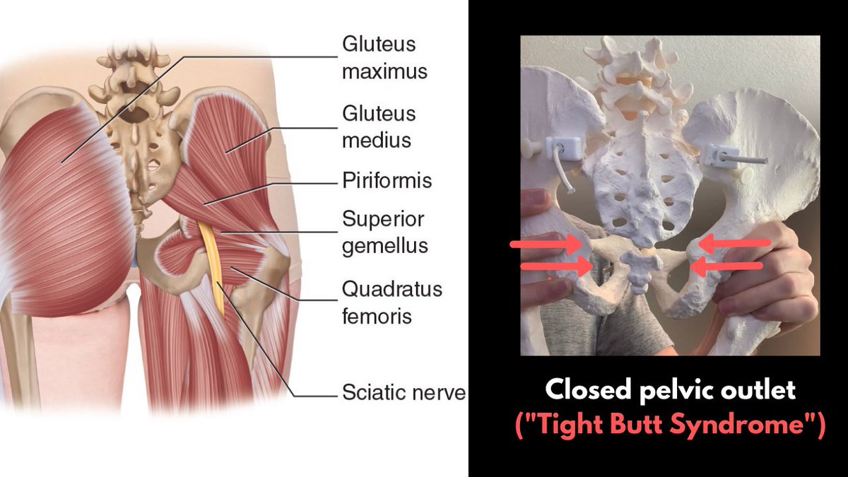 If hips are tight posteriorly, usually the pelvis is in a position where it is the opposite of a hinge - the inlet is open and outlet is closed.