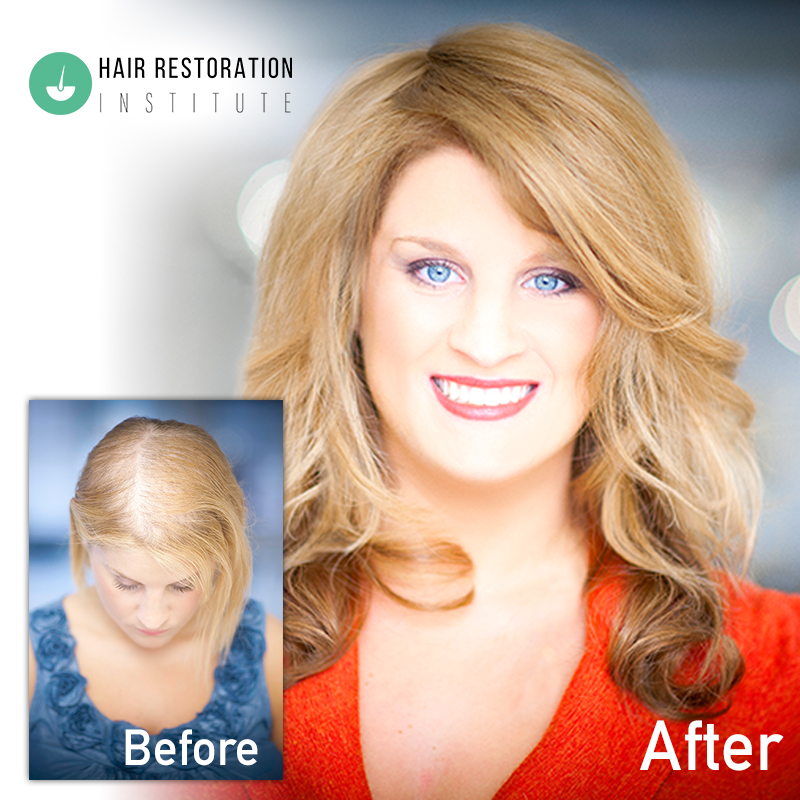hriofmn's tweet photo. HRI’s dermal lens hair replacement for women is ideal for the busy woman with thinning hair. Custom created with 100% natural Euro-texture human hair, your Dermal Lens Effect custom hair system is integrated perfectly into https://t.co/Cjs30alFjt