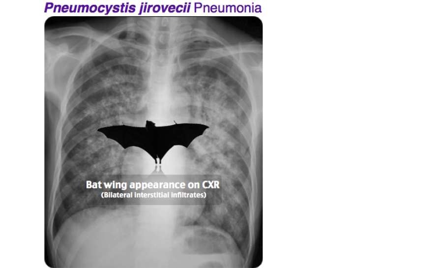 Who the heck is naming these radiology findings?? I don't see a bat wing.

#MedTwitter pls help