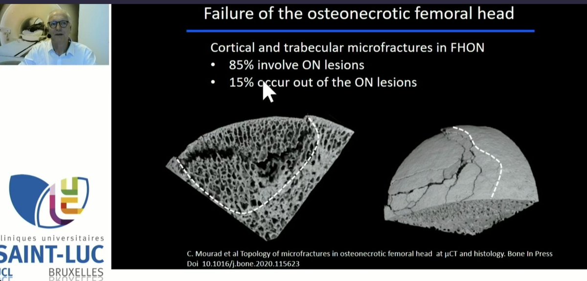Vilavaite's tweet photo. Amazing presentation about femoral head #osteonecrosis #imaging
Great in vitro microfractures micro #CT images
"#Microfractures in viable areas of ON and OA femoral heads: scattered, do not form clusters"
#ISS2020virtual #MSKRad #ISS2020
@intskeletal
https://t.co/1TACBaSwHJ https://t.co/fJa3JzTmUM
