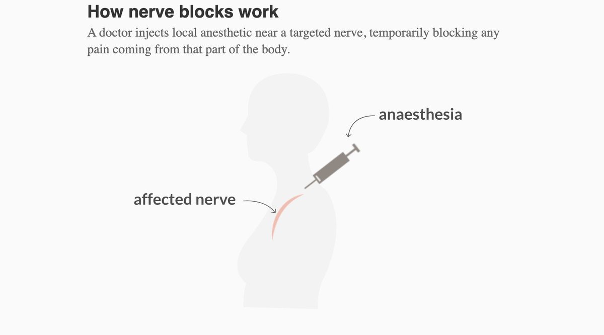 How does it work? Nerve blocks are commonly used before surgeries or to diagnose which nerve is causing a patient pain so health professionals can chart a course on how to treat it.  https://www.thestar.com/news/investigations/2020/09/28/thats-an-injection-mill-ontarios-top-billing-pain-doctors-capitalize-on-provinces-lax-rules-running-up-the-publics-tab-for-chronic-pain-management.html?utm_source=Twitter&utm_medium=SocialMedia&utm_campaign=Health&utm_content=operationtransparency