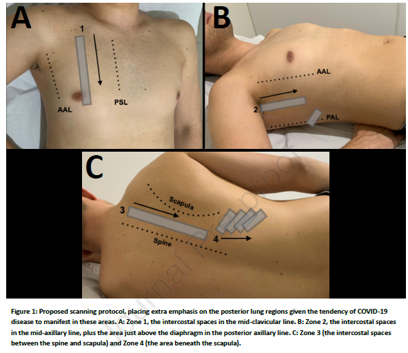 WINFOCUS's tweet photo. New Article: How I do it – Lung Ultrasound for Patients with COVID-19 Pulmonary Disease. Scott J. Millington, MD, Seth Koenig, MD, Paul Mayo, MD, Giovanni Volipcelli, MD https://t.co/RlcTZgOoHR More Info: https://t.co/Va3648O5ln 
@POCUSbot @IM_POCUS @emergencypdx @NephroP https://t.co/t33OOJElHG