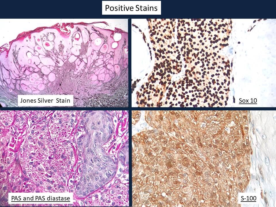 Because of its pseudocarcinomatous hyperplasia, I'm pretty sure that on a shave biopsy, the diagnosis of this cutaneous (neural) granular cell tumor  would have been missed.
 
58 y/o w , trunk
#Dermatology #dermatopat #pathology #skinpath