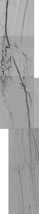 tan_guangming's tweet photo. #CLI b/t gangrene + rest pain. short FA TO manageable by #endofirst, but no outflow. Would you consider prostacyclin infusion before intervention? #CLIfighter #Stopthechop #vasctwitter #cardiotwitter @Angiologist https://t.co/lY9gUM0YDq
