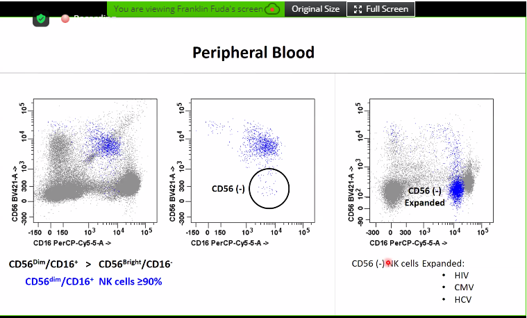 AmeetRKini's tweet photo. One of my favorite topics: NK-cell subsets in the peripheral blood. Very important to be aware of normal subsets to help distinguish from clonal/neoplastic populations! From Dr. Buddy Fuda's workshop at #FlowICCS20 https://t.co/FylCijl7vR
