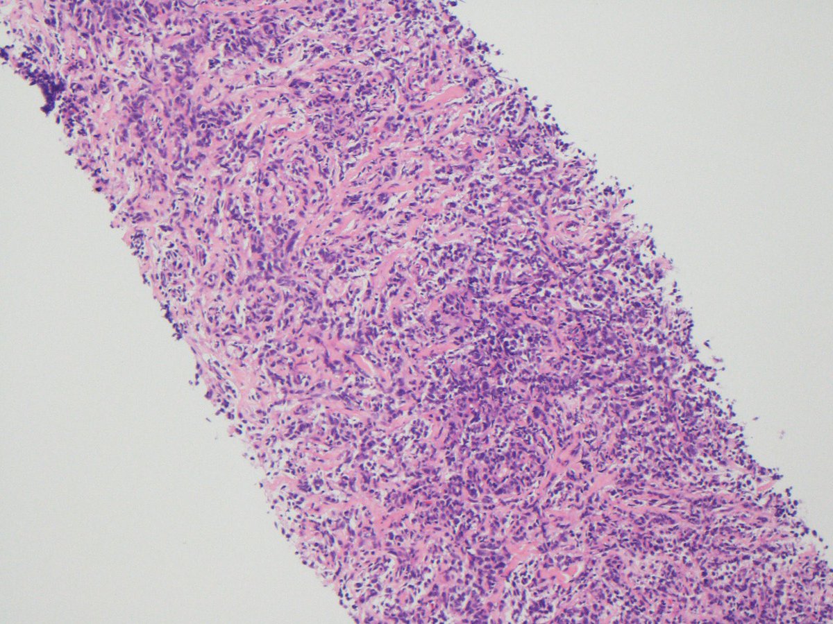 lbsmithmd's tweet photo. Young person (30s) with mediastinal mass. Impending SVC syndrome. What’s your differential and most likely dx? #hemepath #pathology What immunostains? https://t.co/GfAVjJBHeT