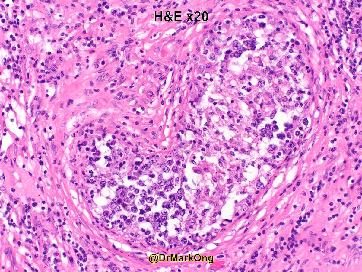 DrMarkOng's tweet photo. Elderly male with testicular mass. #IHC and diagnosis in next tweet. https://t.co/Iwb5zex6oK
