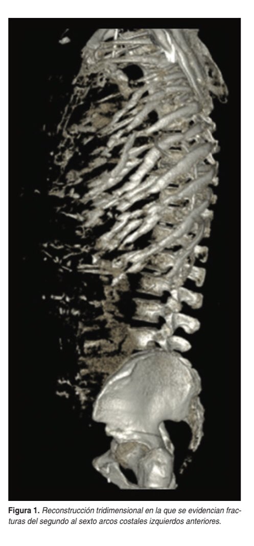 CiruAndes2's tweet photo. Week publication of our program by Drs @brandonapa1996 @RodBarriosMD @CiroPedraza @Sebasti19059022 @PipeCabreraV et al: Early fixation of the flail chest! #SoMe4Surgery #MedTwitter @juliomayol @SWexner @TomVargheseJr @pferrada1 @MISIRG1 @almagoch @docmartin22 @topknife https://t.co/BGMe0Fg5Pf