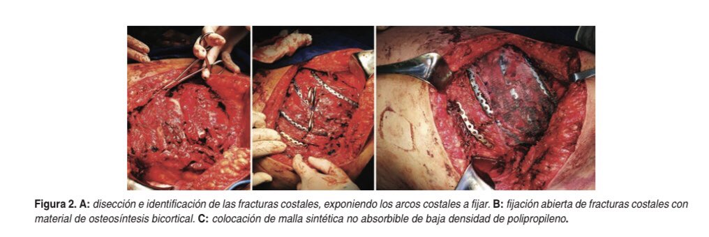 CiruAndes2's tweet photo. Week publication of our program by Drs @brandonapa1996 @RodBarriosMD @CiroPedraza @Sebasti19059022 @PipeCabreraV et al: Early fixation of the flail chest! #SoMe4Surgery #MedTwitter @juliomayol @SWexner @TomVargheseJr @pferrada1 @MISIRG1 @almagoch @docmartin22 @topknife https://t.co/BGMe0Fg5Pf