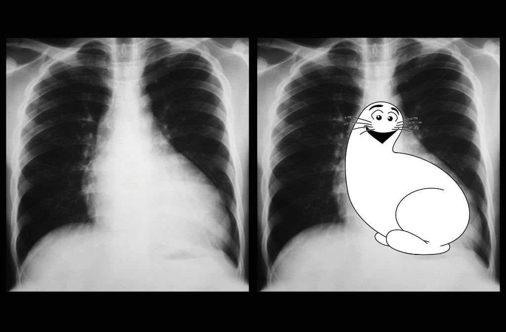 3. In medicine, a "Shmoo sign" seen on an X-ray describes left ventricular enlargement associated with some conditions.